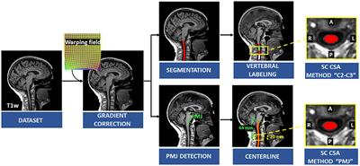 Automatic measure and normalization of spinal cord cross-sectional area using the pontomedullary junction